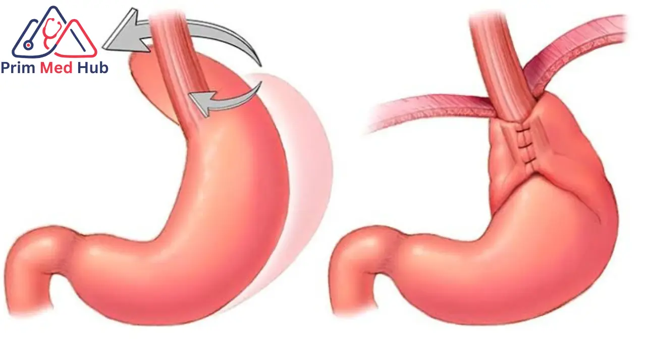 عملية نيسن لعلاج ارتجاع المريء
