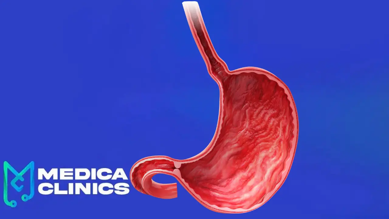 أسباب نزيف المعدة وعلاجه