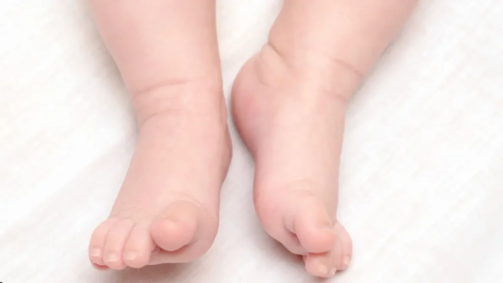 أعراض تقوس الساقين عند البنات