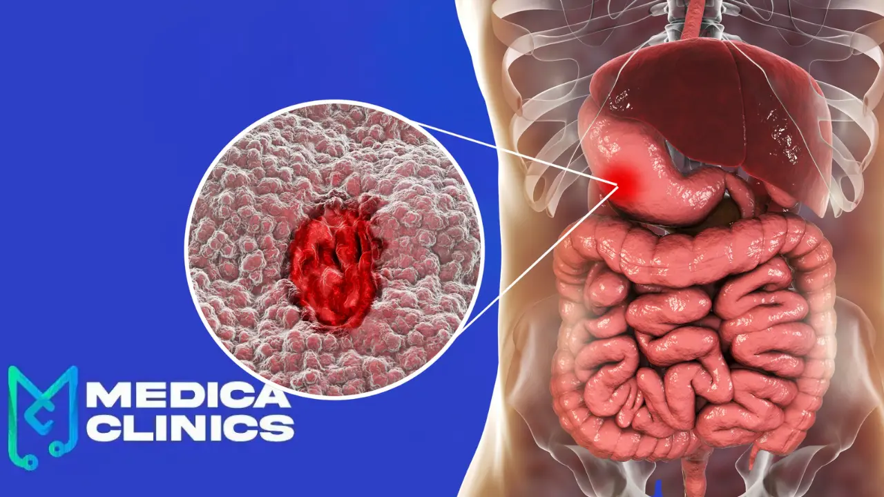 عملية قرحة المعدة: متى نلجأ إليها؟ أنواعها وخطواتها, image size:1280x720