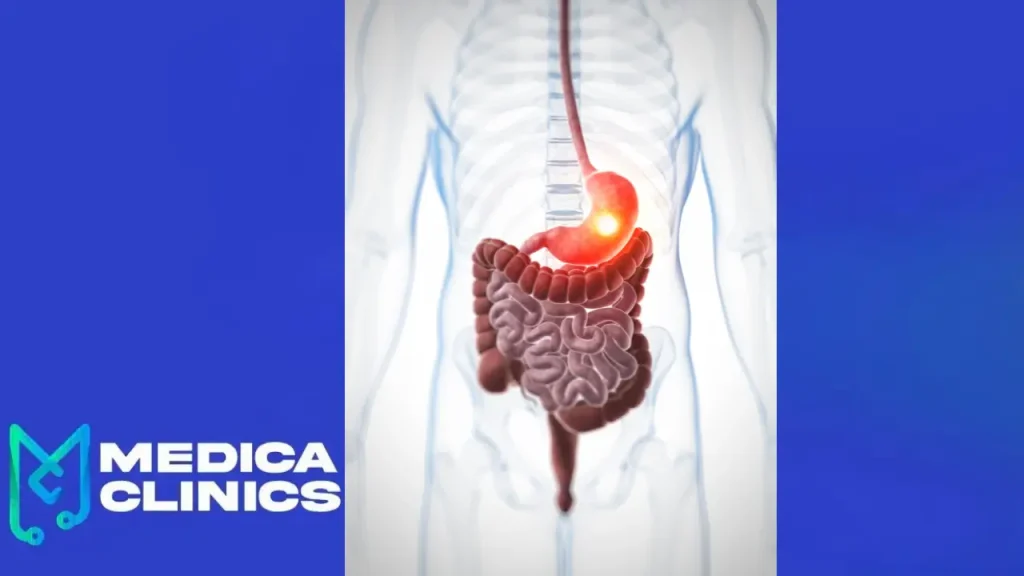 علاج جرثومة المعدة في أسبوع