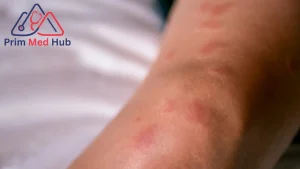 تعرف على أهم 5 أعراض الذئبة الحمراء المبكرة