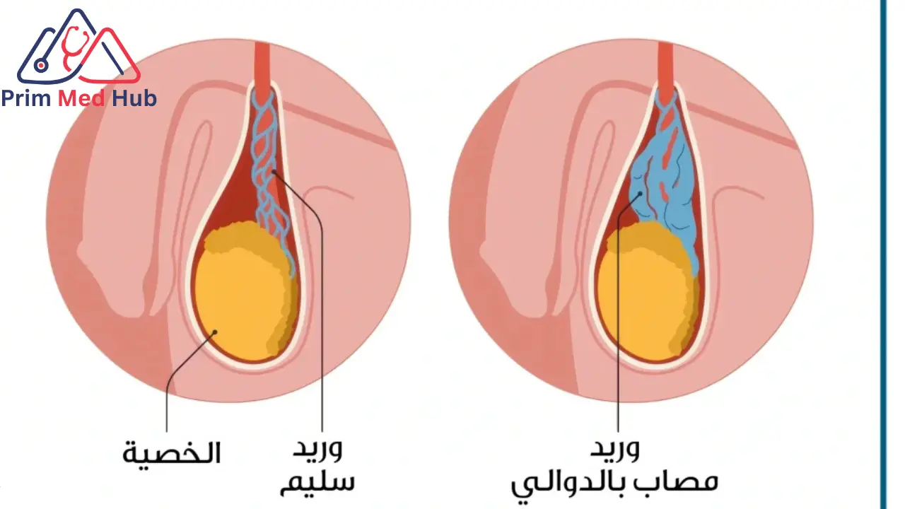 تعرف علي تكلفة عملية دوالي الخصية بالليزر​ - Prim Med Hub