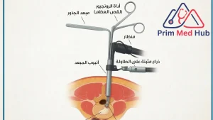 تكلفة عملية الانزلاق الغضروفي بالمنظار في مصر - Prime Med