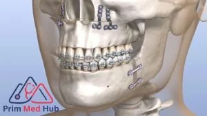 كيف تجرى عملية جراحة الفك فى مصر؟ - Prim Med Hub