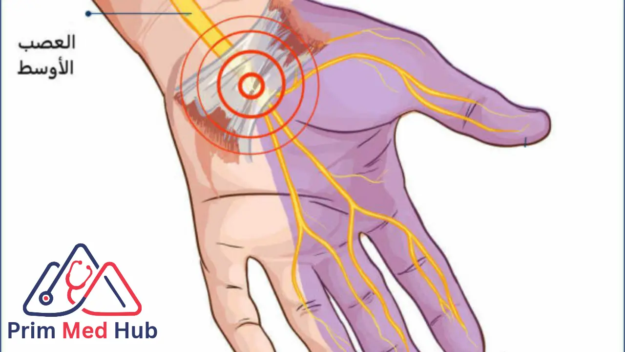 إصابات الأوتار وقطع اعصاب اليد- متى تحتاج جراحة ميكروسكوبية؟ - Prim MedHub