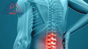 علاج الانزلاق الغضروفي بدون جراحة أم عملية؟ - Prim Med Hub